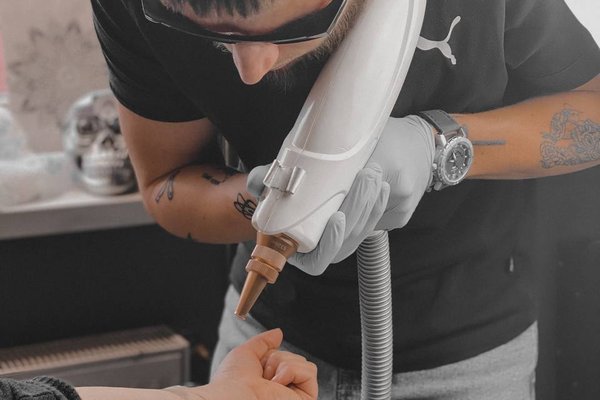 Tattoo verwijderen in Eindhoven