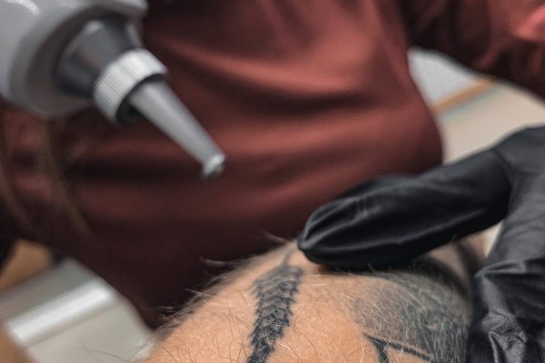 Tattoo verwijderen in Eindhoven