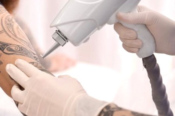 Tattoo verwijderen in Eindhoven