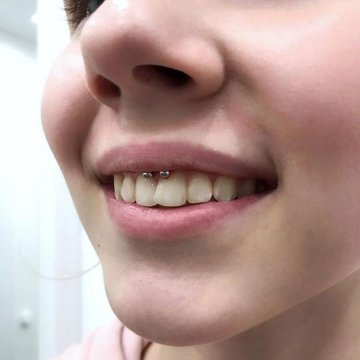 smiley piercing verzorgen
